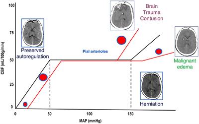 Escalate and De-Escalate Therapies for Intracranial Pressure Control in Traumatic Brain Injury